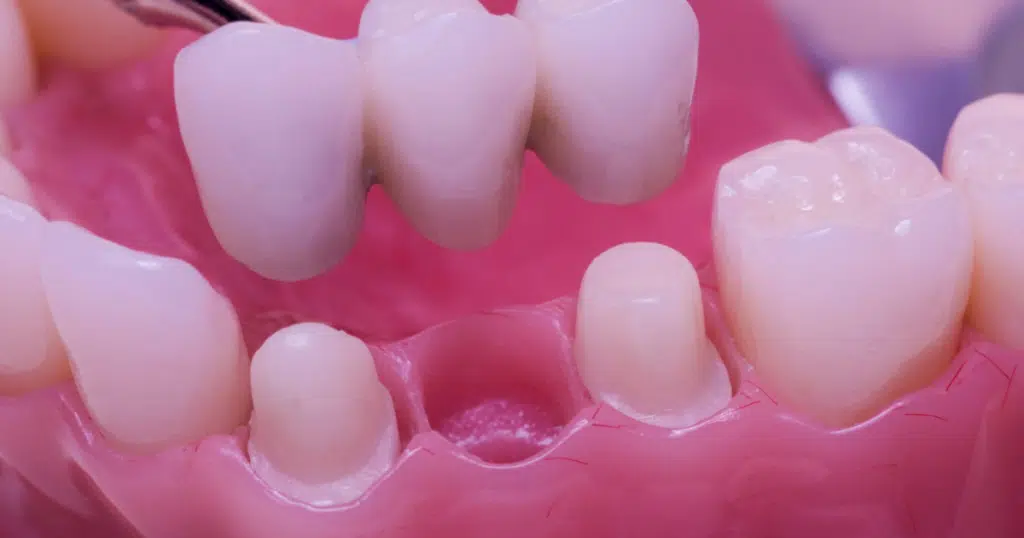Dental Bridges - Summit Dental Doylestown - featured image