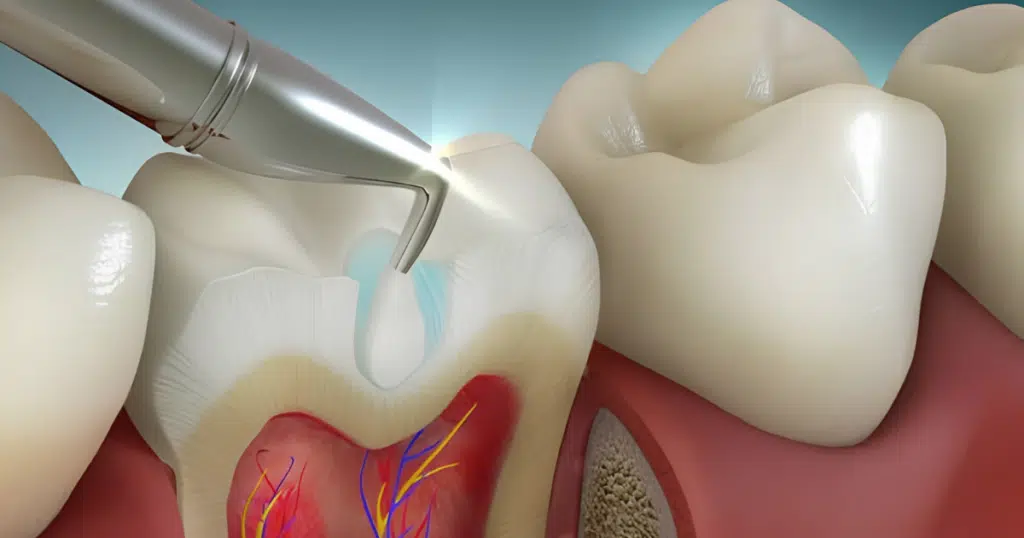 Dental Fillings - Summit Dental Doylestown - featured image
