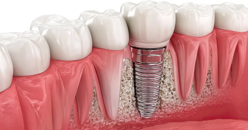 Dental Implants - Summit Dental Doylestown - featured image