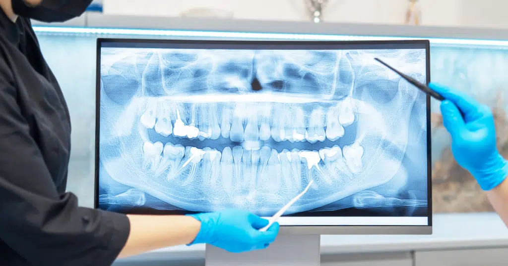 Digital X-Rays - Summit Dental Doylestown - featured image