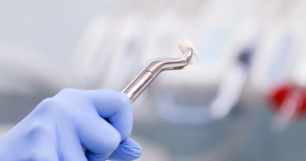 Extractions - Summit Dental Doylestown - featured image