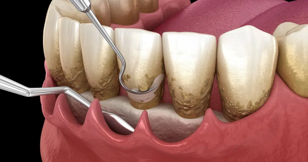 Periodontal Care - Summit Dental Doylestown - featured image