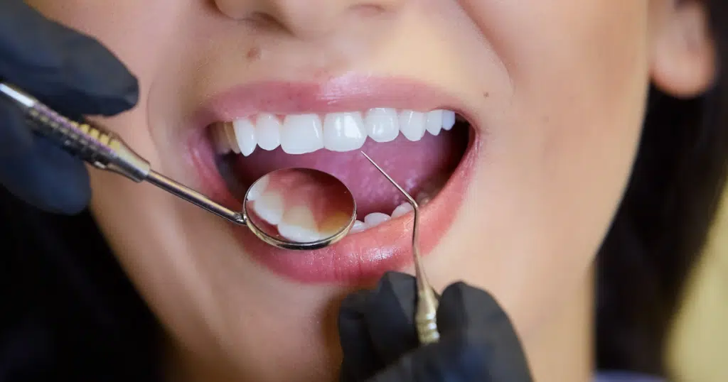 Preventive Dentistry - Summit Dental Doylestown - featured image