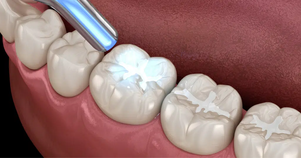 Restorative Dentistry - Summit Dental - featured image