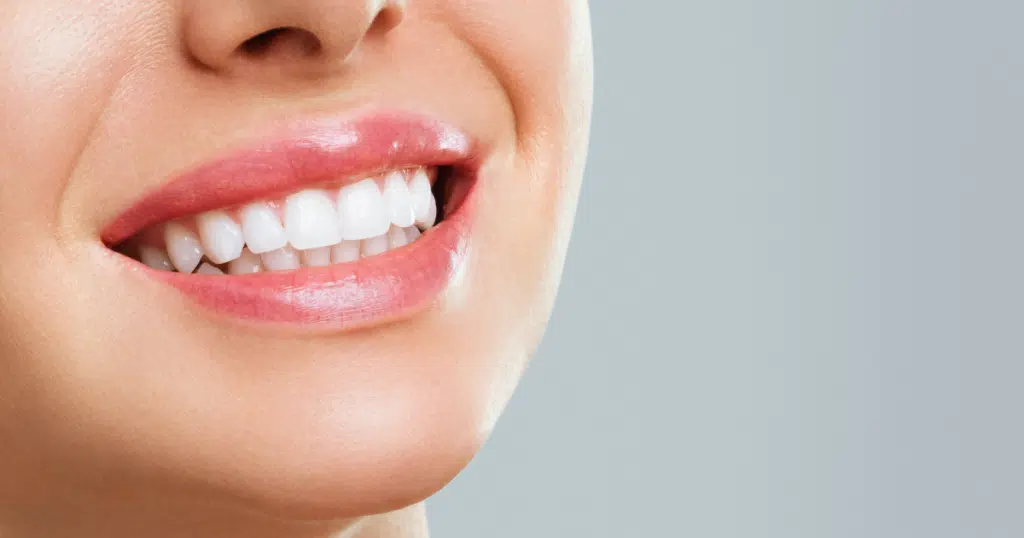 Teeth Whitening - Summit Dental Doylestown- featured image