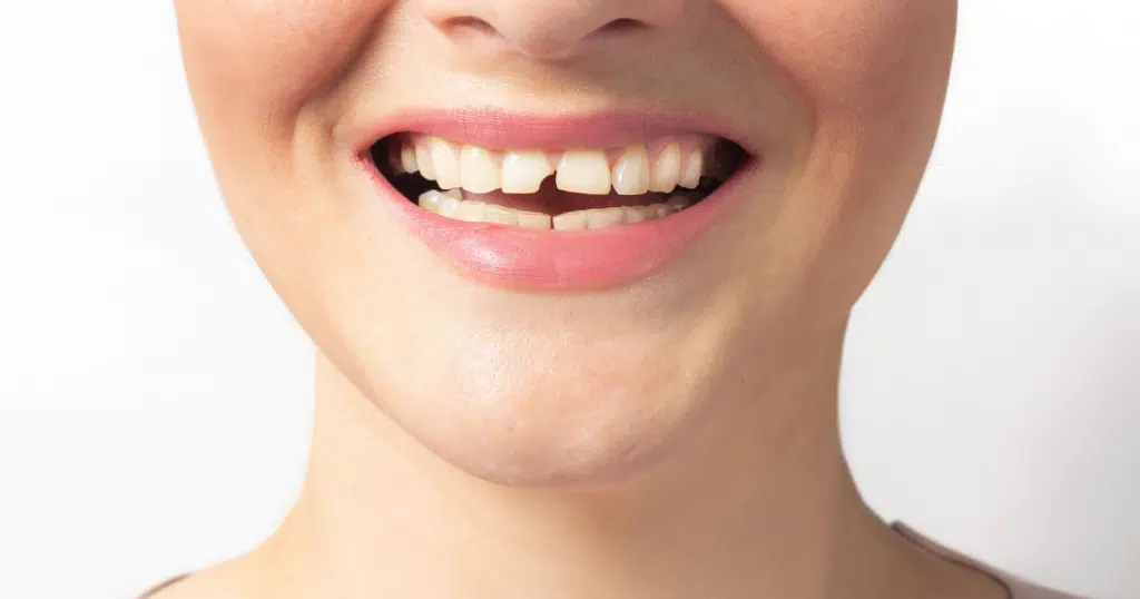 Trauma & Injuries - Summit Dental Doylestown- featured image